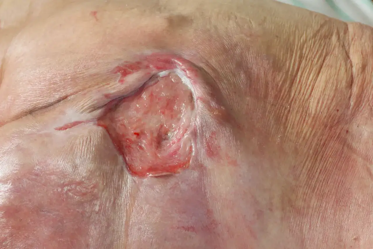 Piaga da decubito che sanguina, con tessuto rosso vivo e bordi infiammati. La pelle circostante appare sottile e rugosa.