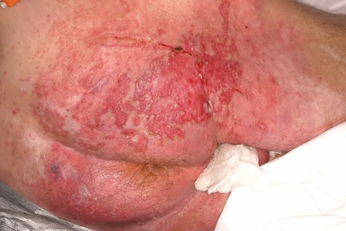 Grave dermatite da incontinenza con lesioni cutanee arrossate, umide e infiammate nell'area perianale.