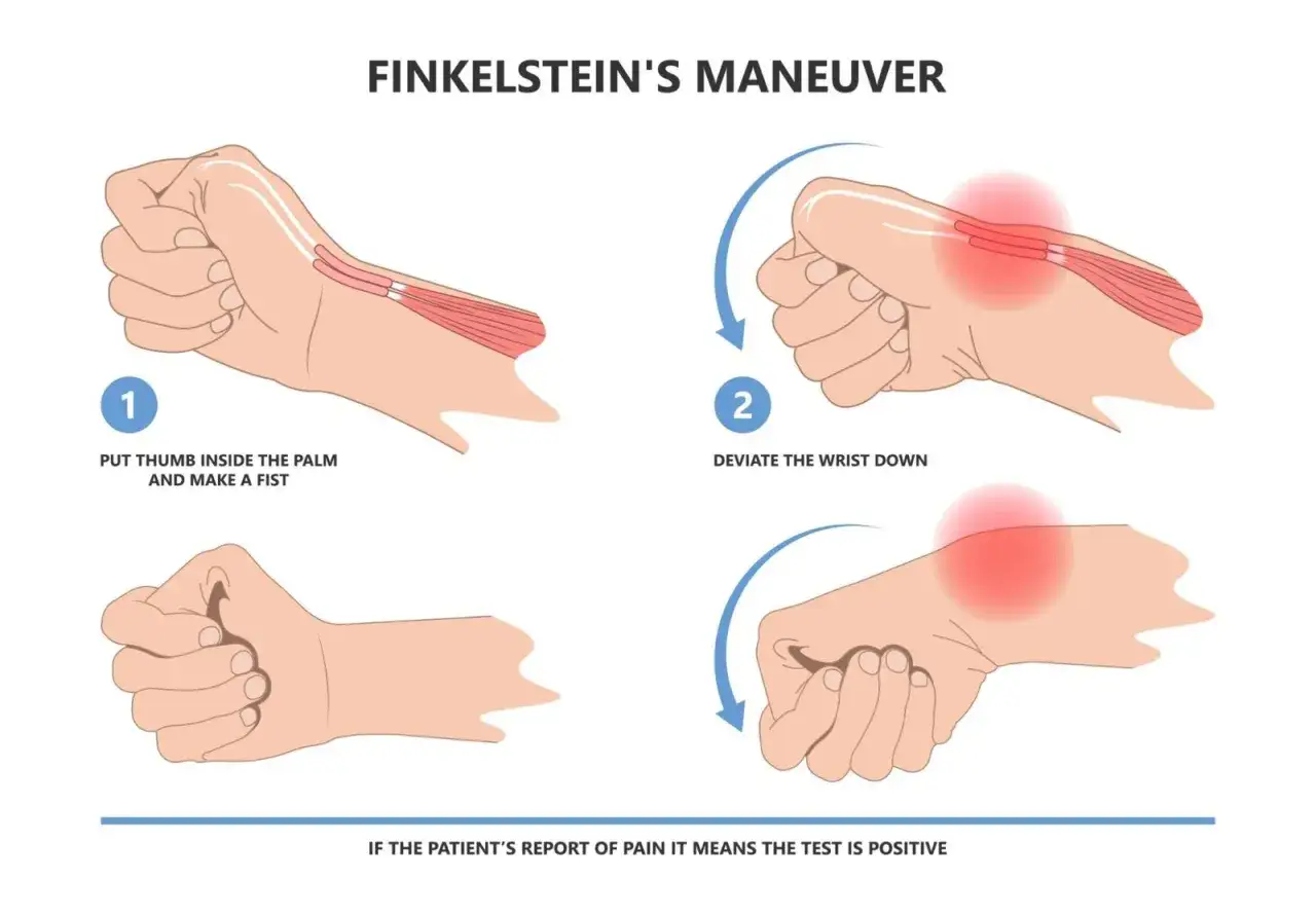 Manovra di Finkelstein per diagnosticare il morbo di Quervain: chiudere il pugno col pollice dentro e piegare il polso verso il basso.
