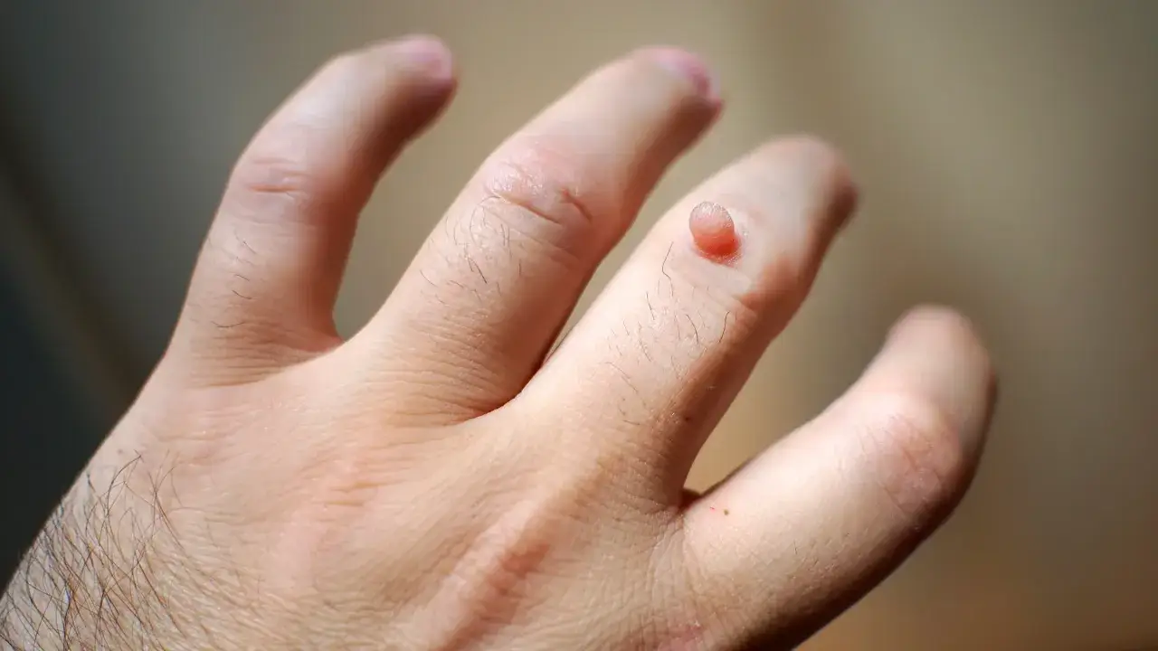 Una piccola verruca sporge dal dito di una mano, con la pelle circostante leggermente arrossata.