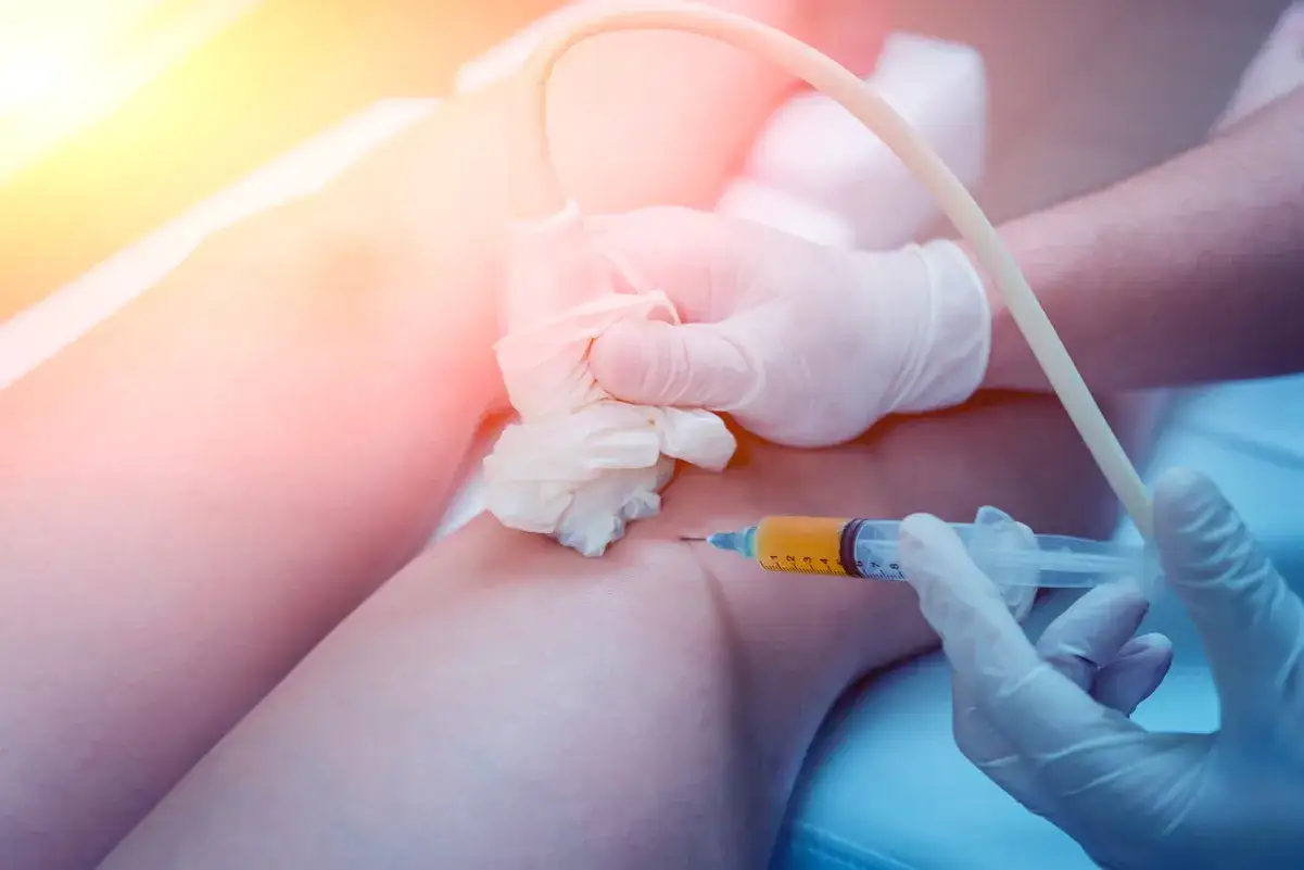 Mano con guanto in lattice esegue iniezione di plasma nel ginocchio, guidata da ecografo. Nonostante il fastidio, fa male togliere il liquido dal ginocchio.