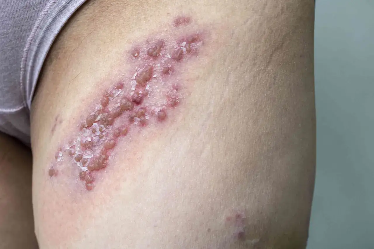 Eruzione cutanea con vescicole e arrossamento sulla coscia, causa di prurito alle anche.