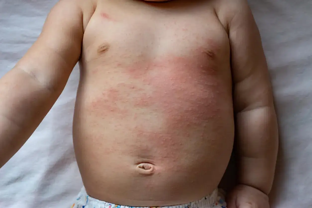 Pelle arrossata e irritata sul petto di un neonato, con piccole pustole. Potrebbe essere un eritema da sudore, comune nei mesi caldi.