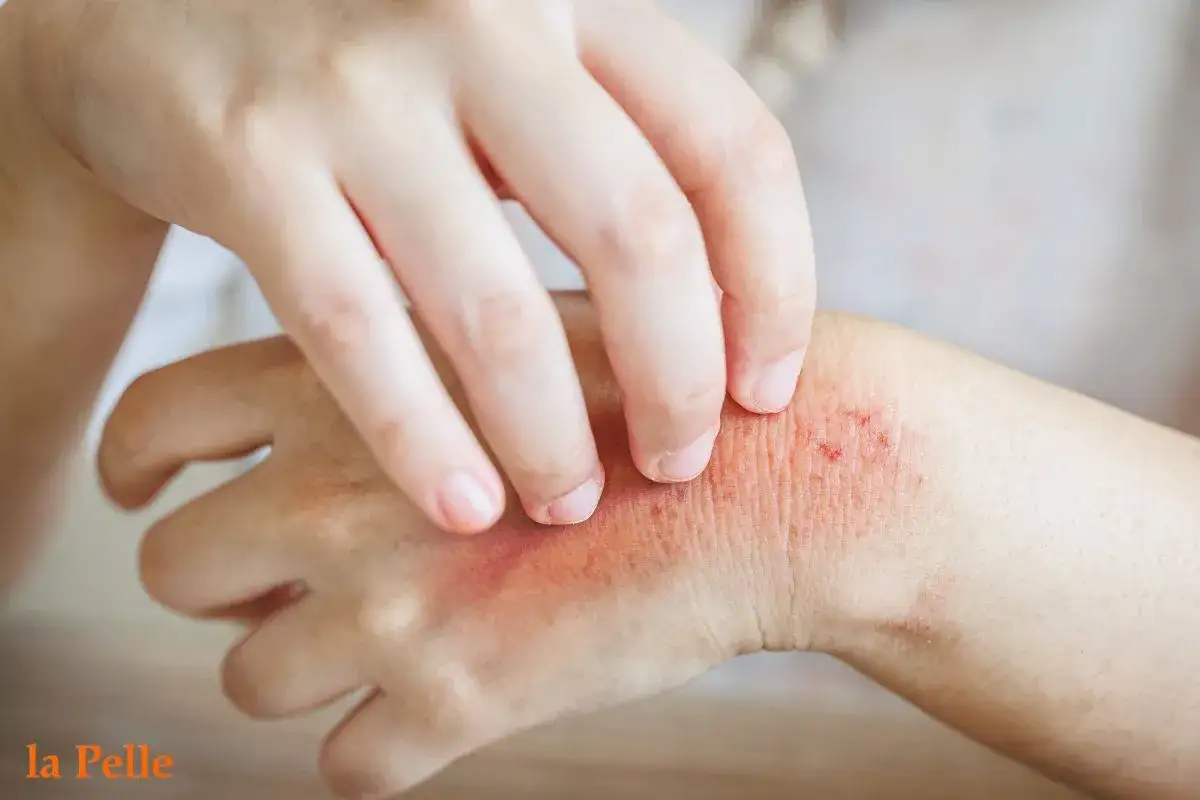 Mano che si gratta un'eruzione cutanea arrossata e irritata, un esempio di prurito sine materia.