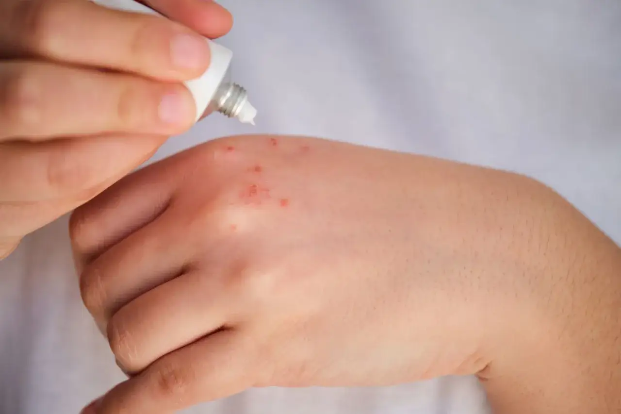 Mani con eruzione cutanea e arrossamento, applicazione di crema per alleviare il prurito alle mani.