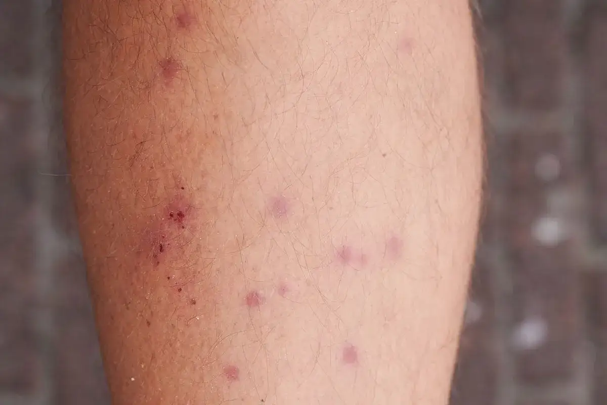 Punture di acaro sulla pelle, rossastre e pruriginose. La durata della puntura di acaro varia, ma queste sembrano recenti.