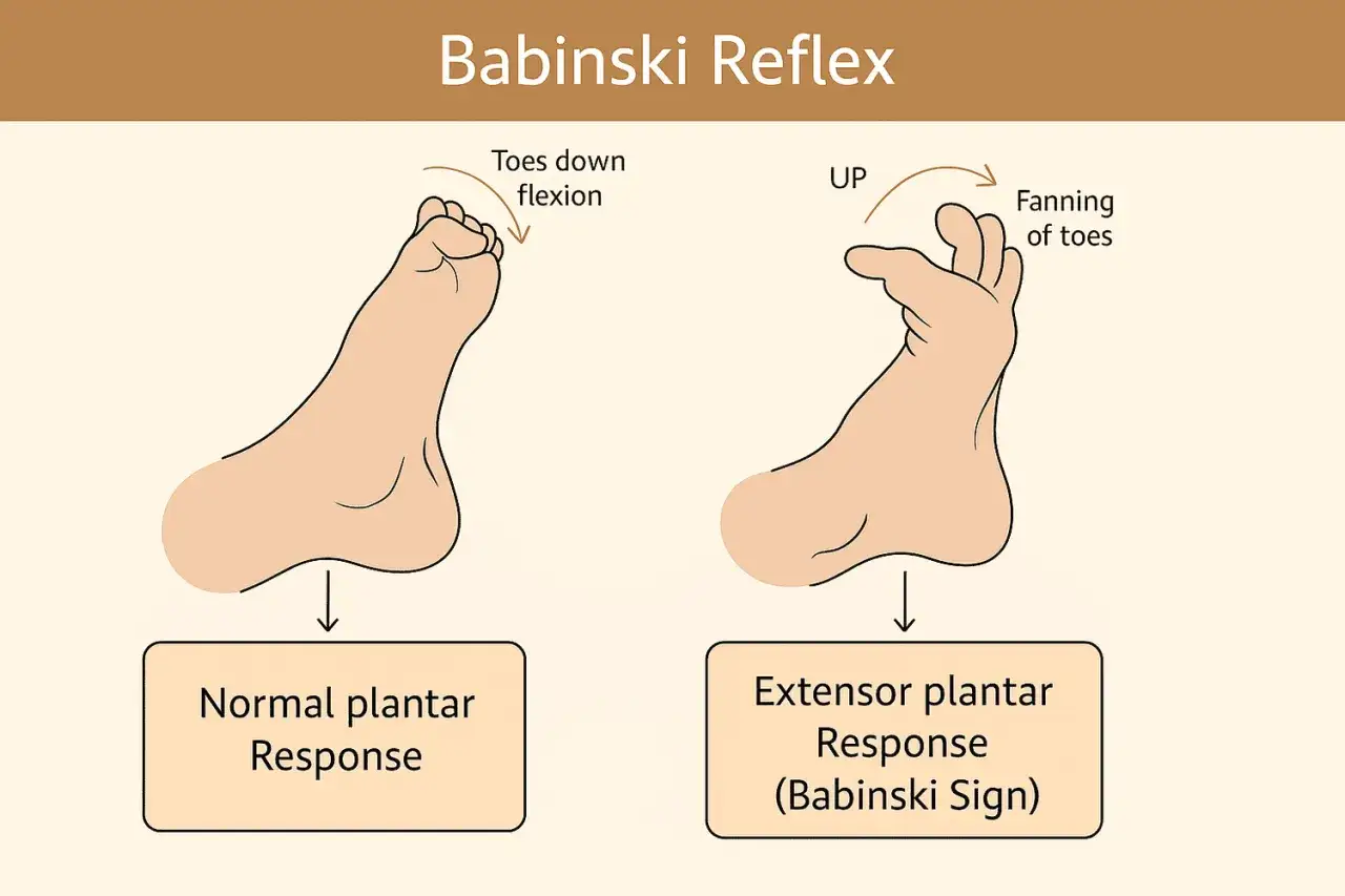 Il riflesso di Babinski: la risposta plantare normale con le dita flesse e la risposta estensoria con le dita a ventaglio.