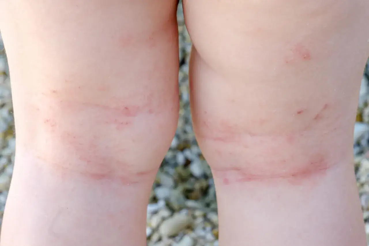 Gambe di bambino con arrossamenti e piccoli puntini da sudore, forse dovuti al caldo o a un'irritazione cutanea.