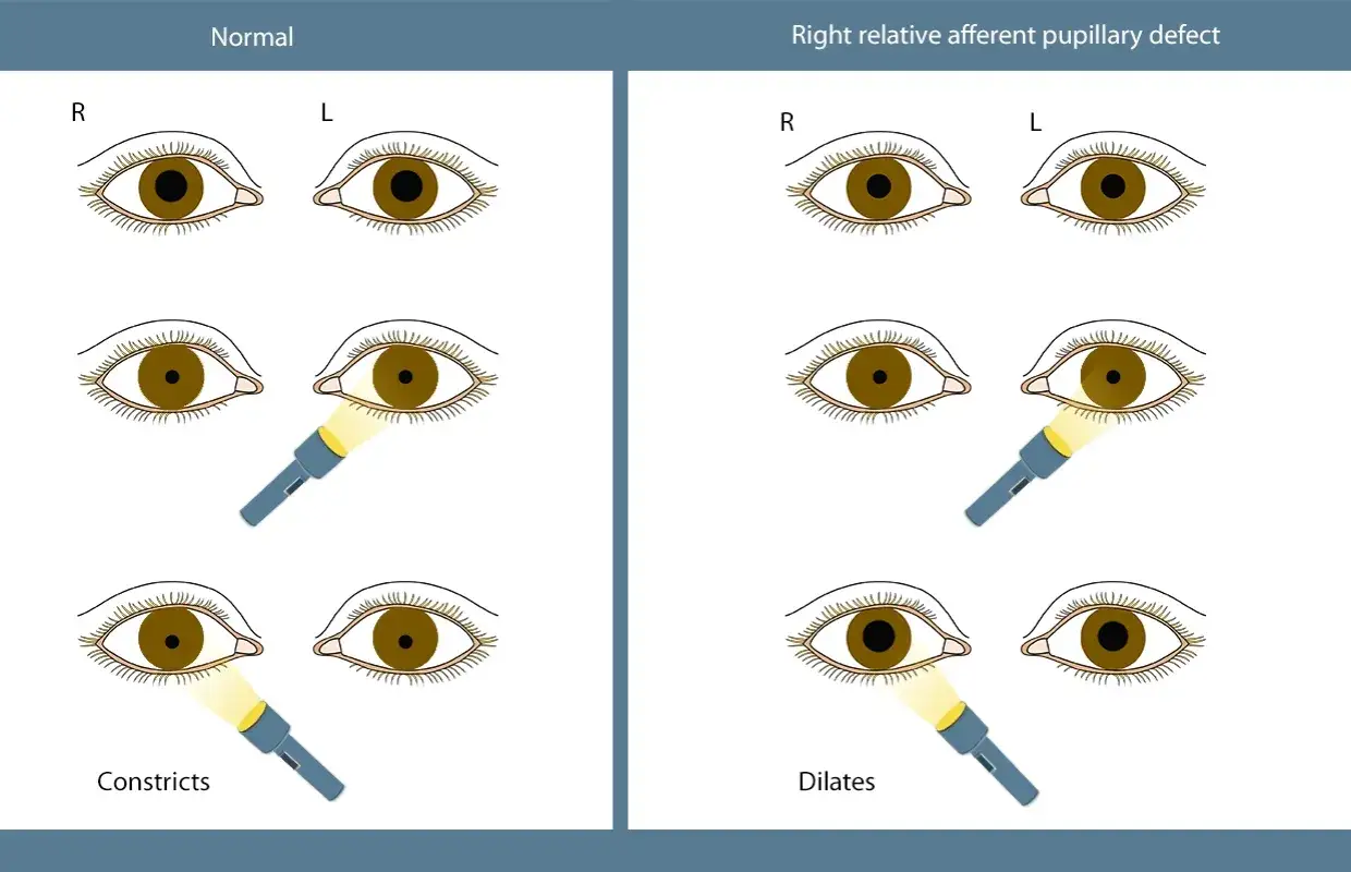 Confronto tra occhi normali con pupille isocoriche e un occhio con difetto pupillare afferente relativo destro, dove la pupilla si dilata alla luce.