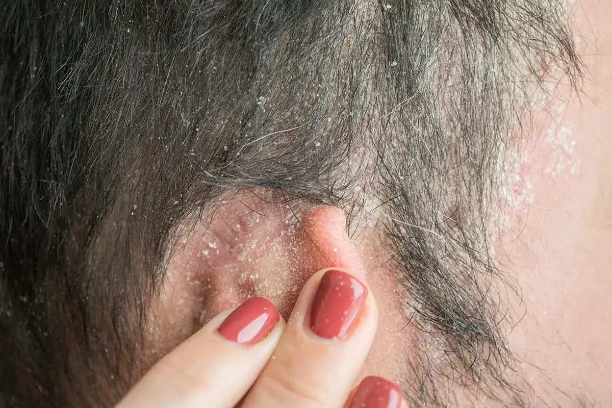 Dettaglio del cuoio capelluto con squame bianche e arrossamento, sintomo di dermatite atopica.
