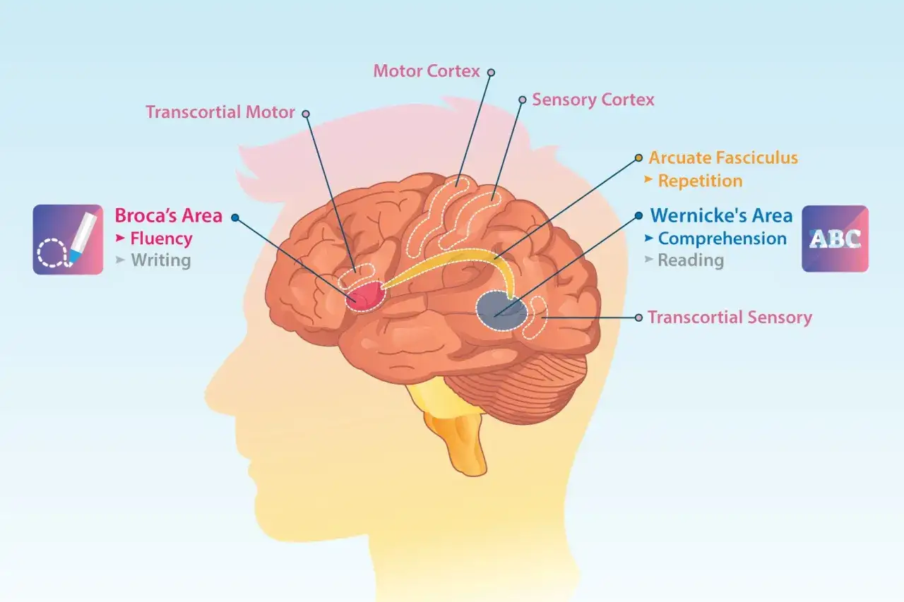 Schema del cervello che illustra le aree legate al linguaggio. L'area di Broca, associata alla fluidità e alla scrittura, è evidenziata in rosso. Un danno qui può causare incapacità di parlare.