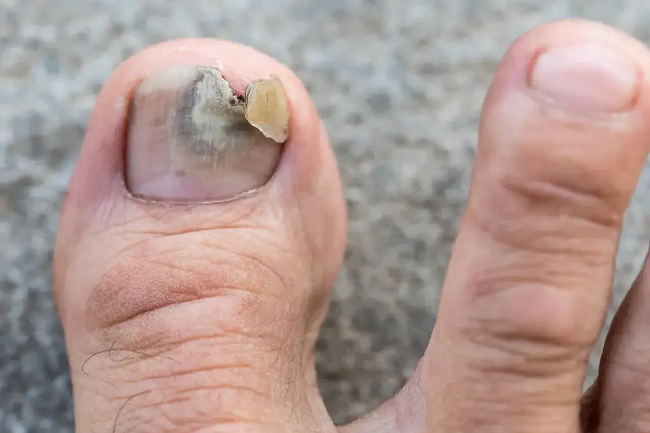 Unghie doppie piedi: unghia del piede con ispessimento e scheggiatura, che mostra segni di infezione fungina.