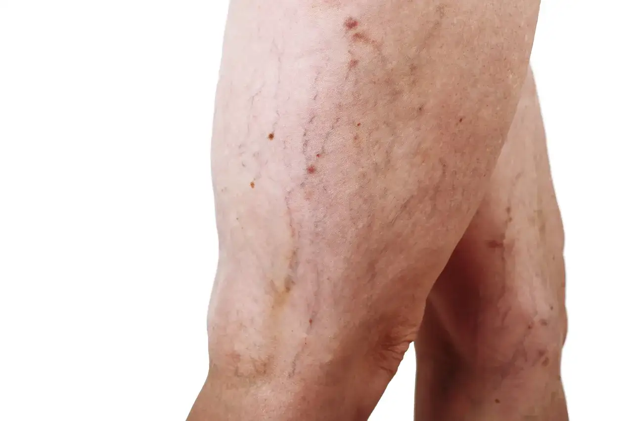Gambe con teleangectasie e vene visibili. C'è speranza che i capillari rotti si possano riassorbire.