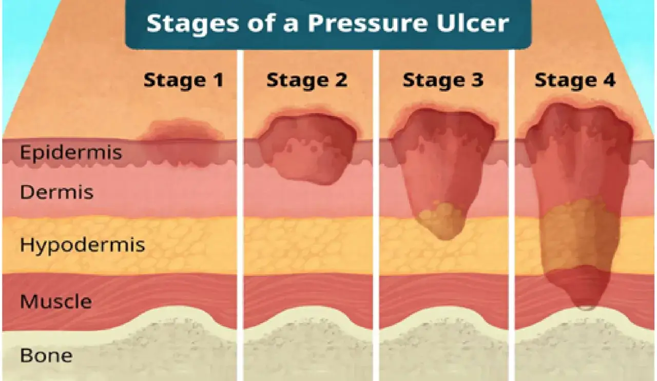 Illustrazione delle 4 fasi di piaghe da decubito, che diventano sempre più profonde e dolorose, danneggiando epidermide, derma, ipoderma, muscolo e osso.