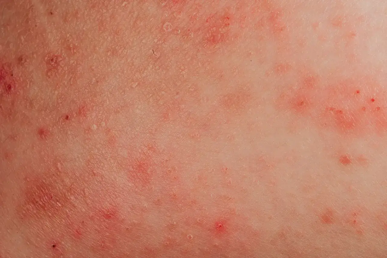 Pelle arrossata con piccole pustole e squame, che ricorda la falsa scabbia.