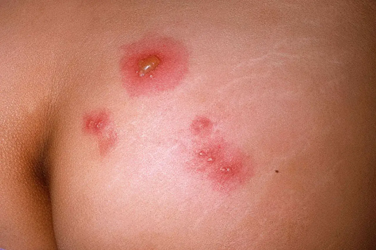 Sedere arrossato adulto con vescicole e arrossamenti, possibili cause di irritazione o infezione.