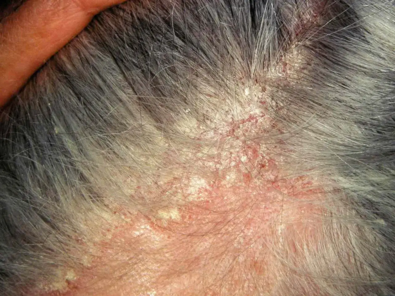 Close-up del cuoio capelluto di una persona anziana con capelli grigi, dove si notano evidenti croste in testa, arrossamenti e desquamazioni.