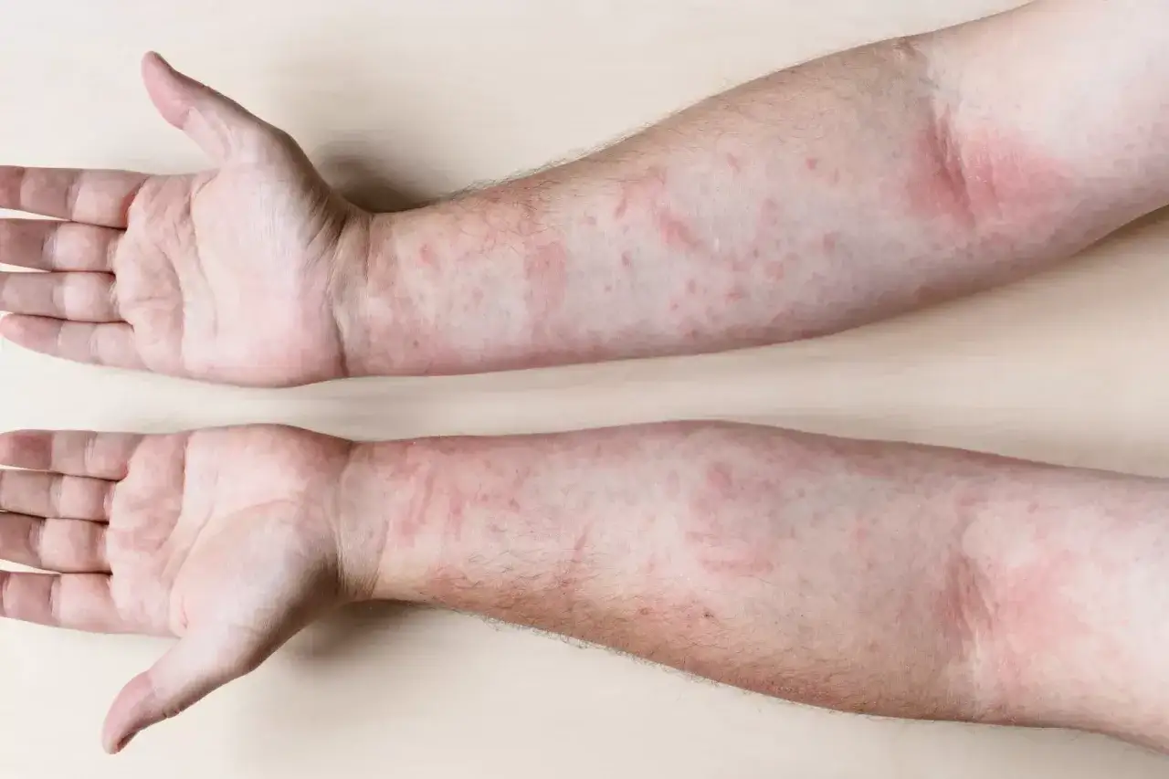 Braccia e mani con eruzioni cutanee rosse e pruriginose, sintomo di una possibile allergia al nichel.