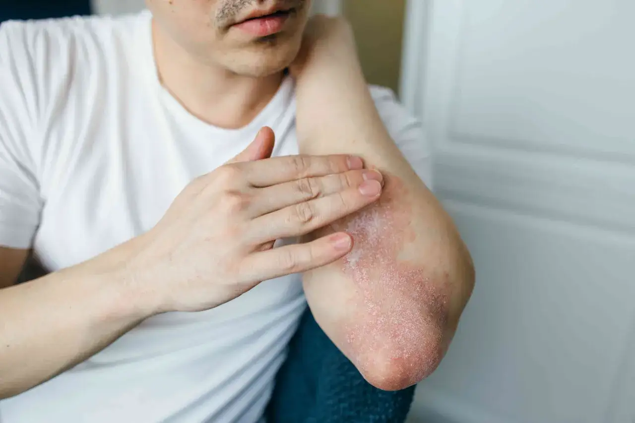 Uomo con prurito psicosomatico ai gomiti, applica una crema lenitiva.