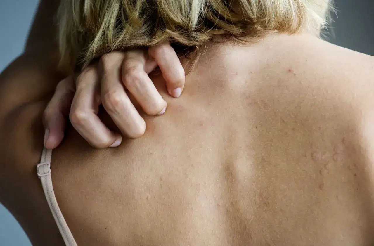 Mano che si gratta la schiena, cercando rimedi per il prurito. Piccole irritazioni visibili sulla pelle.