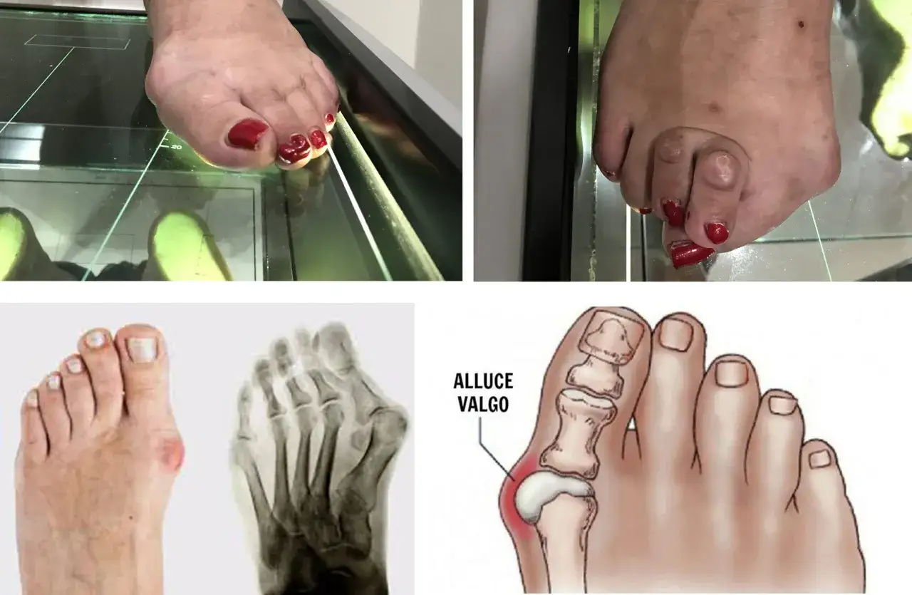 Il podologo cosa fa: esamina alluce valgo con radiografie e illustrazioni anatomiche per diagnosi e cura.