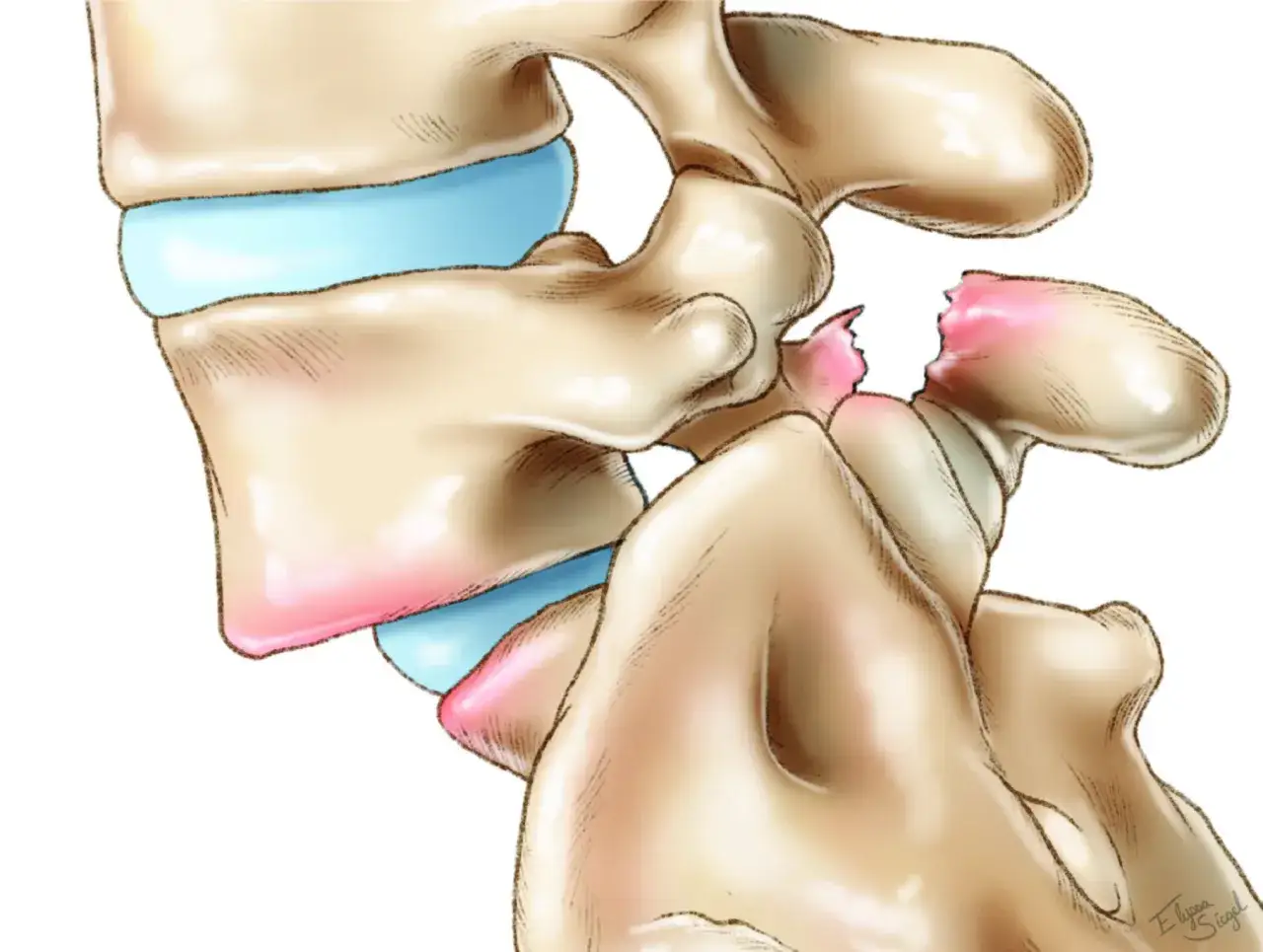 Illustrazione di una spondilolistesi con frattura vertebrale, che può causare sintomi neurologici.