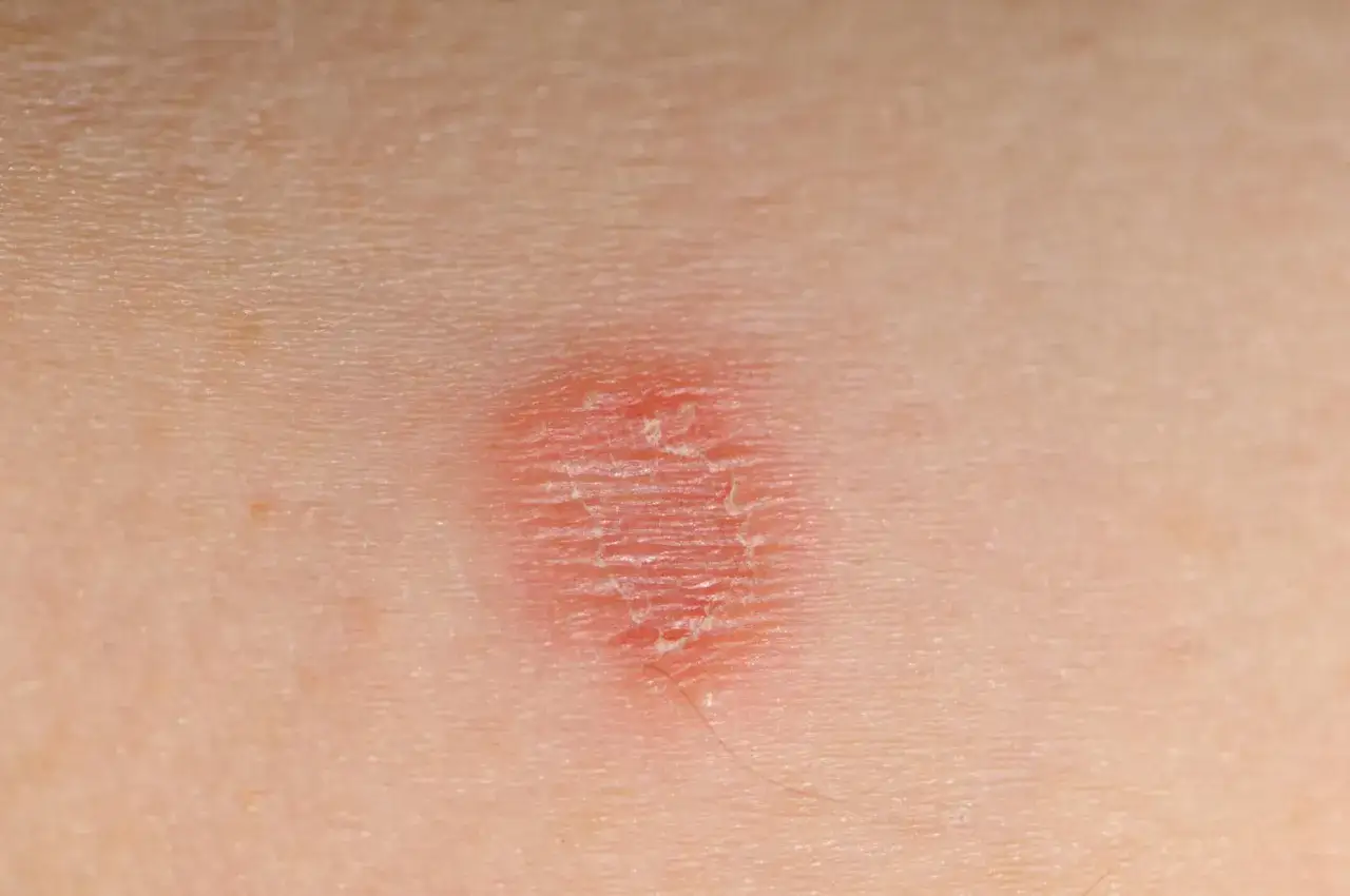Una macchia rossa sulla pelle circolare, con la pelle secca e screpolata al centro.