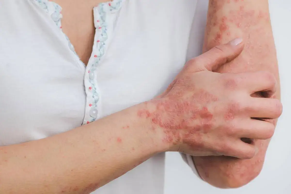 Braccia e mani con chiazze rosse e squamose, un segno visibile di come la psoriasi possa influenzare la vita quotidiana, anche se non è mortale.