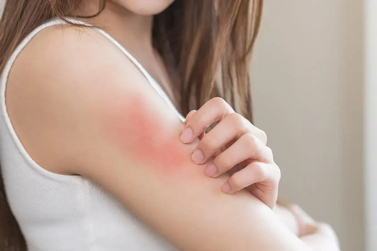 Donna si gratta il braccio, mostrando un'area arrossata e irritata, sintomo di prurito nelle spalle.