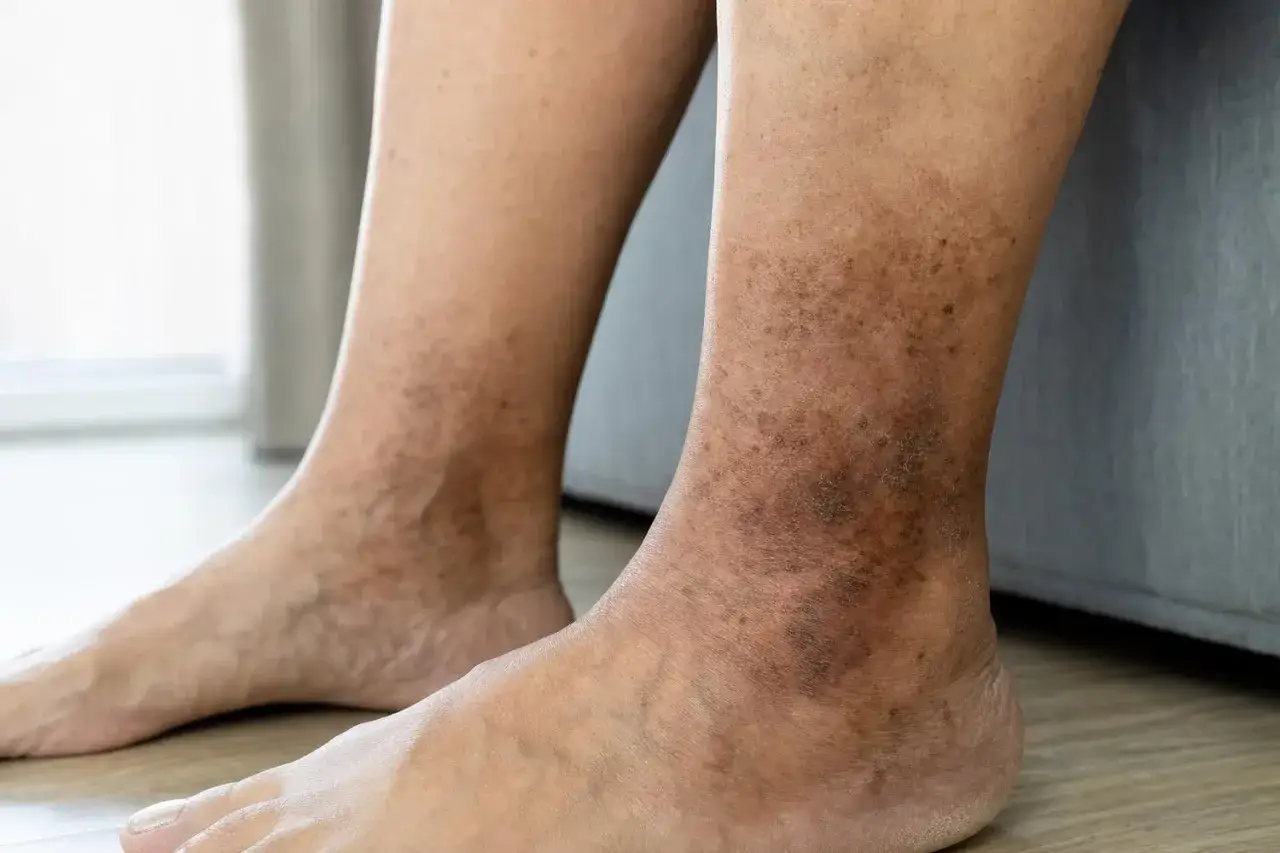Gambe con macchie scure, segno di problemi di circolazione. La pelle presenta discromie e un aspetto irregolare.