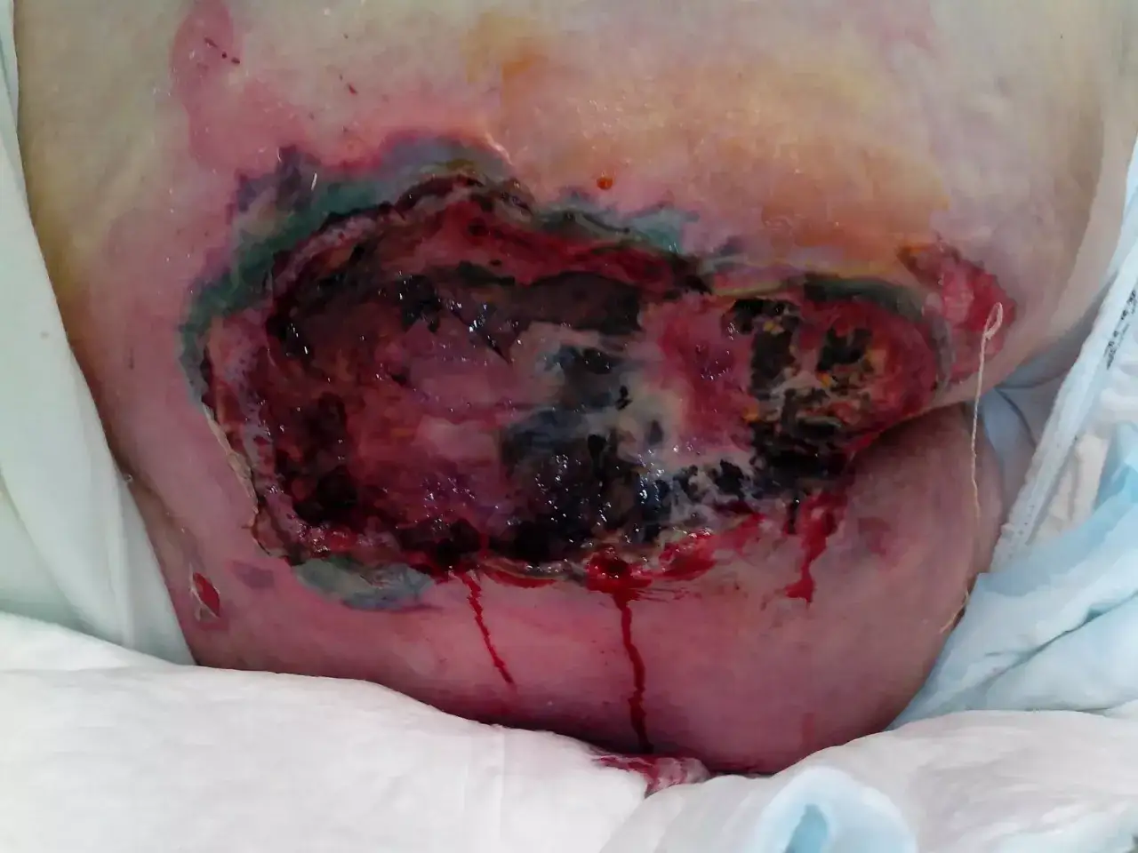 Grave piaga da decubito sull'osso sacro, con necrosi e essudato ematico.