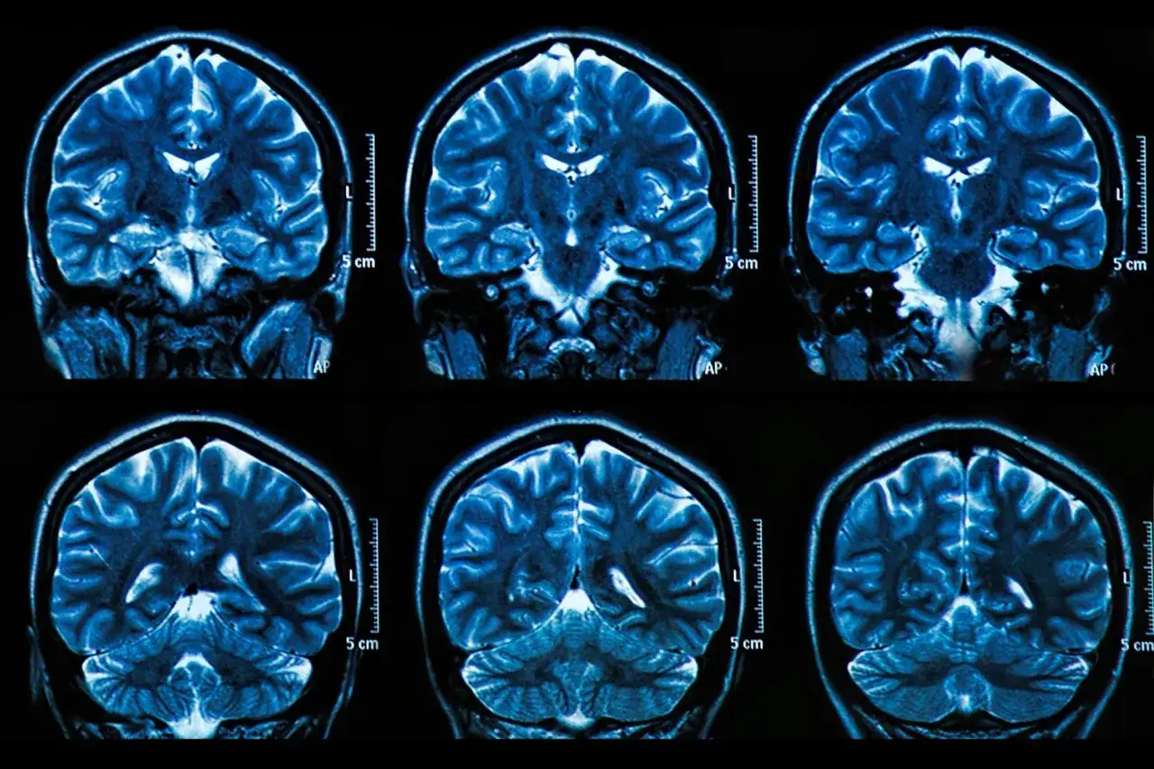 Sei scansioni RM del cervello umano, che mostrano la complessità cerebrale, utili per indagare la perdita di memoria a 50 anni.