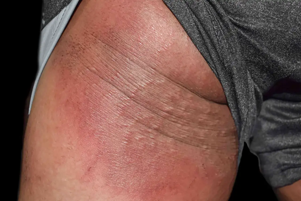 Pelle arrossata e irritata con piccole vescicole, tipica di una dermatite sedere adulto.