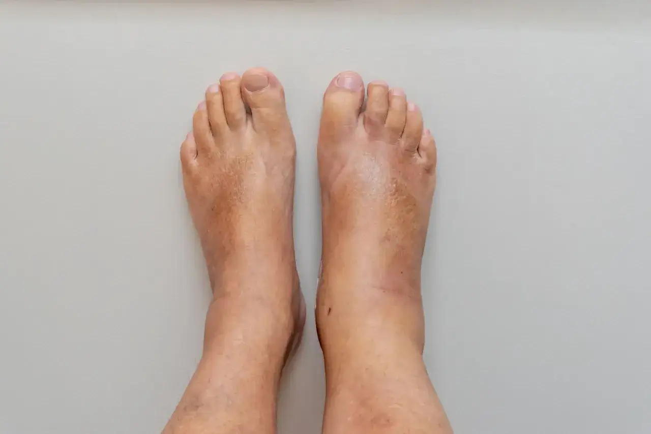 Piedi gonfi di anziani, segno di un cuore stanco.