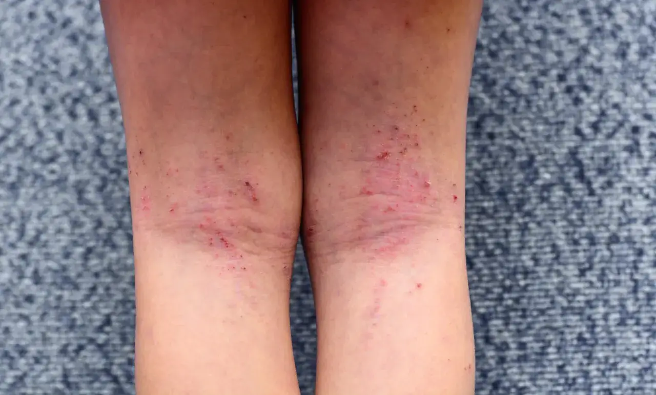 Gambe con prurito e puntini rossi, pelle irritata e secca sulle ginocchia.