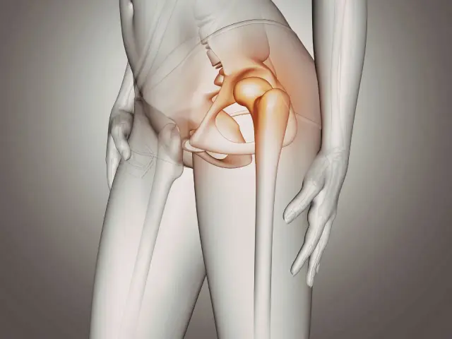 Illustrazione anatomica che evidenzia la borsite all'anca, con l'area infiammata in arancione.